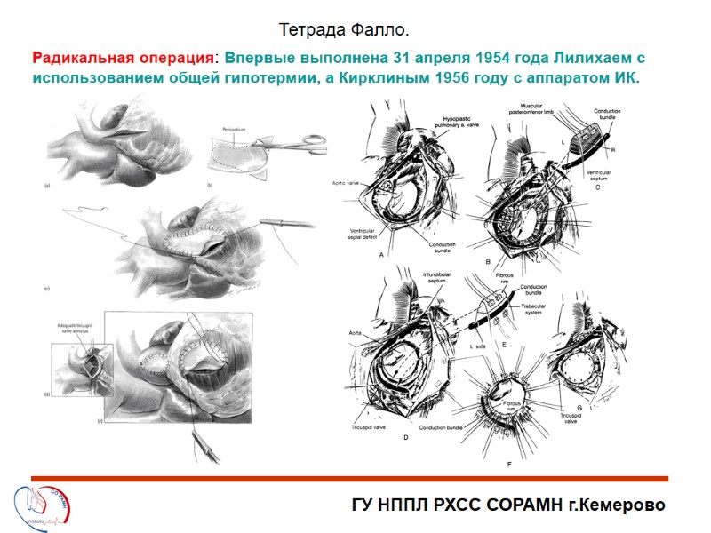 ГУ НППЛ РХСС СОРАМН г.Кемерово Тетрада Фалло. Радикальная операция: Впервые выполнена 31 апреля 1954